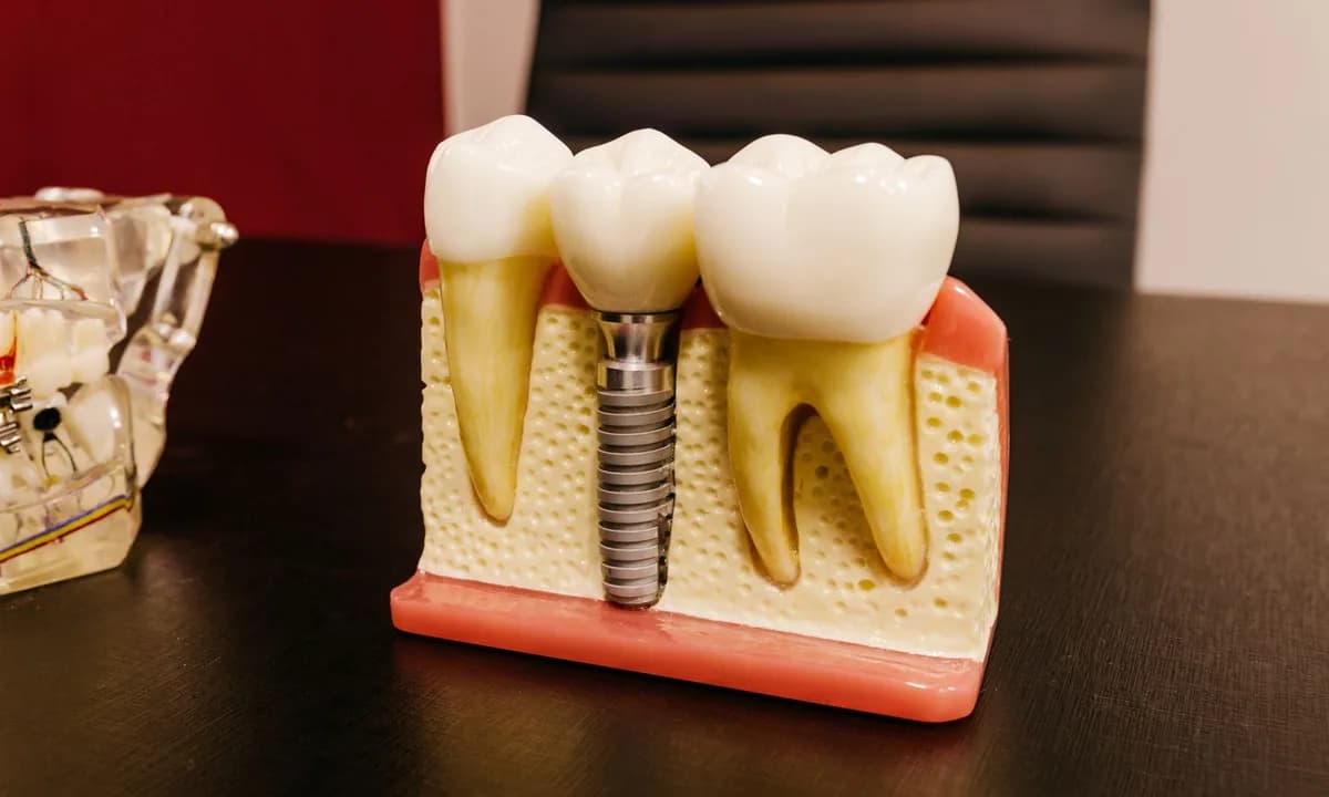 Diş kökü, implant ve kronu gösteren kesitli eğitim modeli