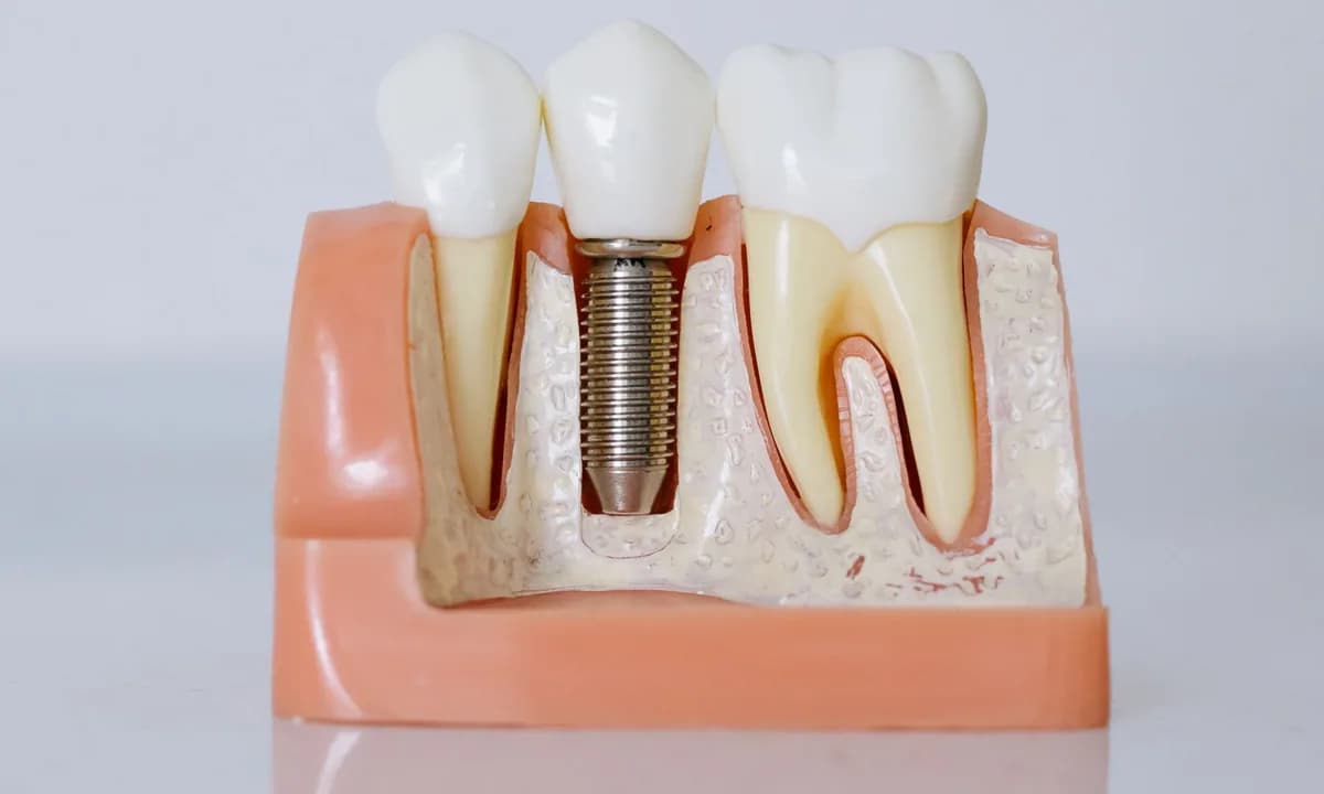 Şeffaf model içinde implant ve diş köklerinin yakın görünümü